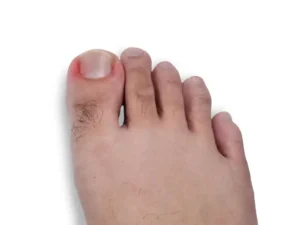 ציפורן חודרנית