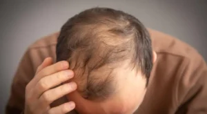אלופציה אנדרוגנטית
